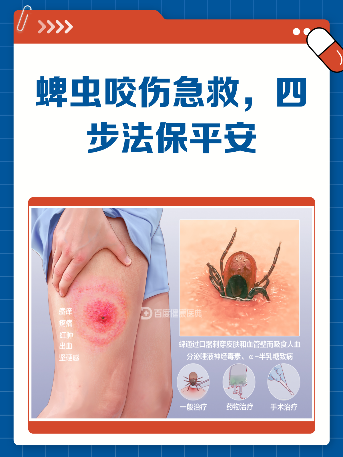 蜱虫咬伤怎么办?急诊抢救四步法来帮忙!