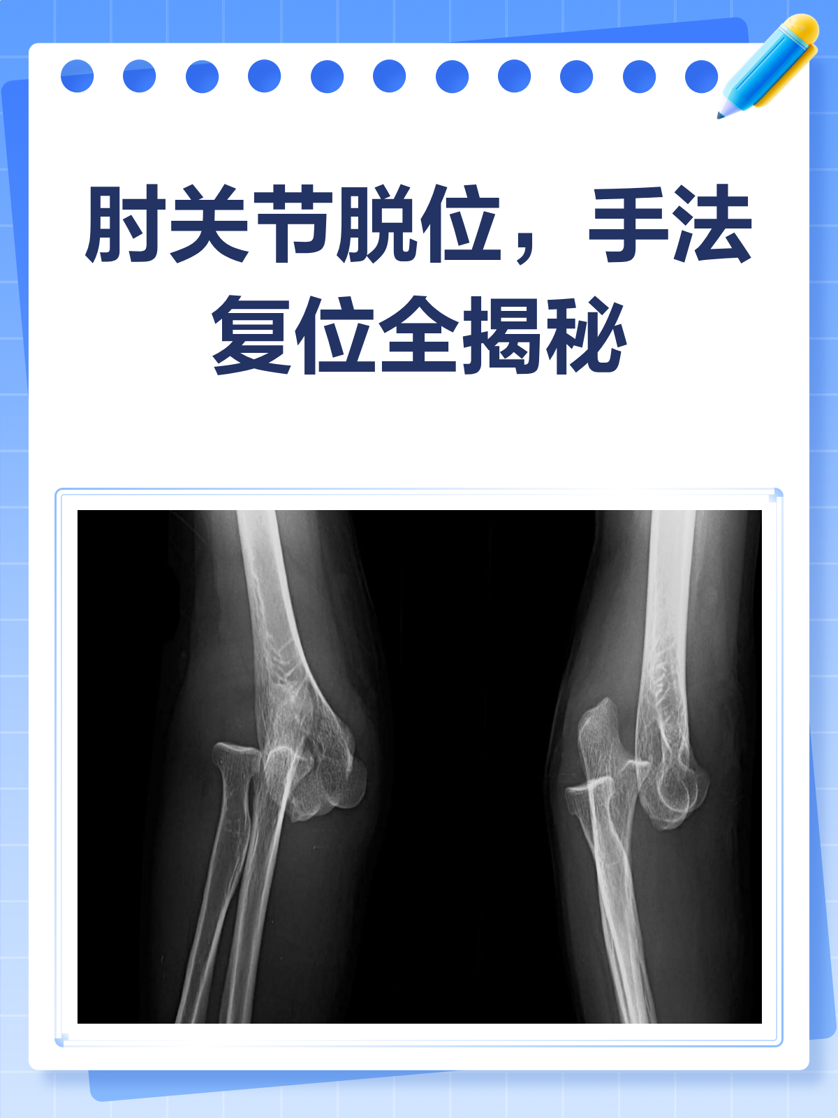 肘关节脱位?手法复位秘籍来啦!💪