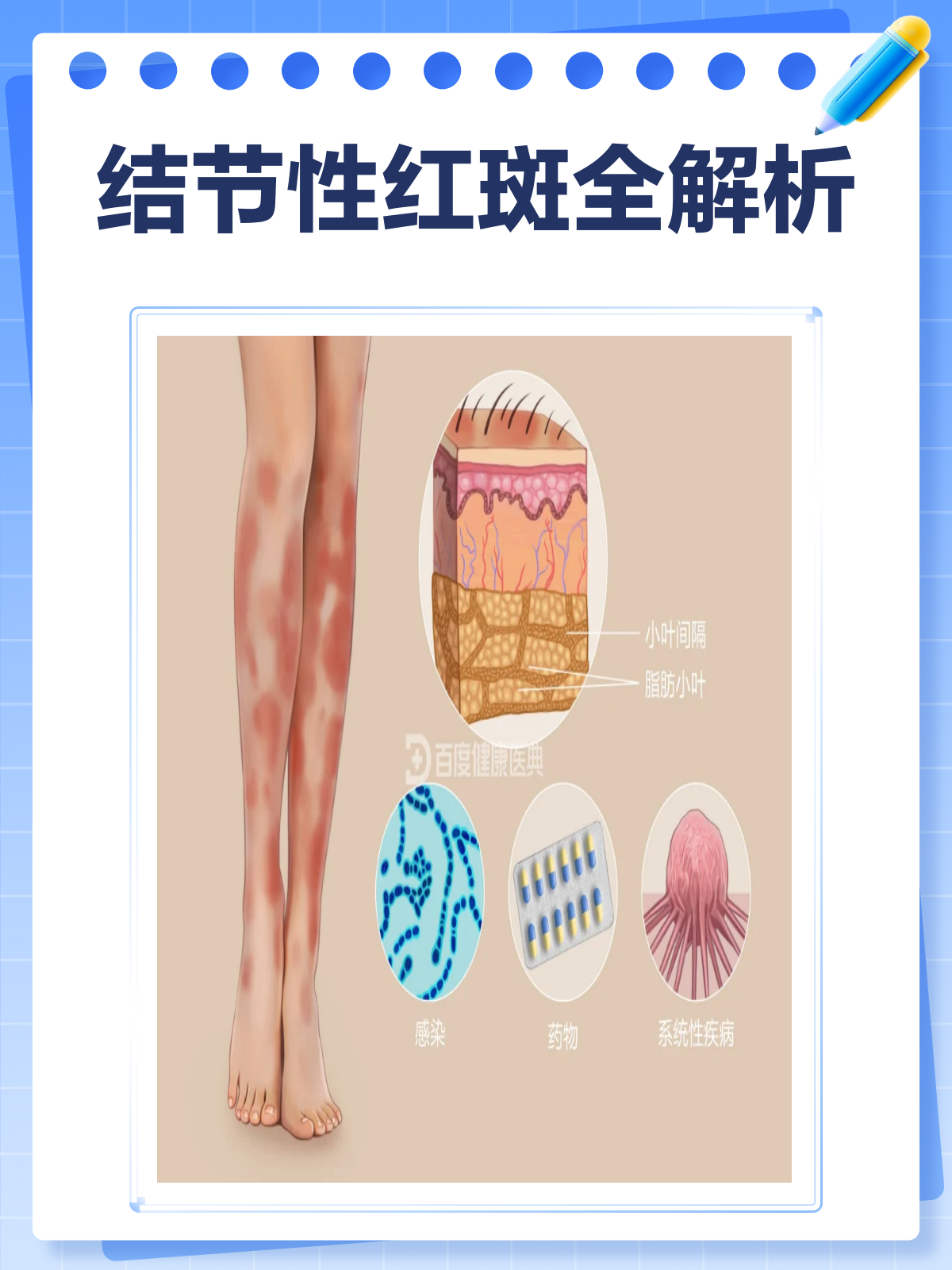 结节性红斑,你了解多少?🔍