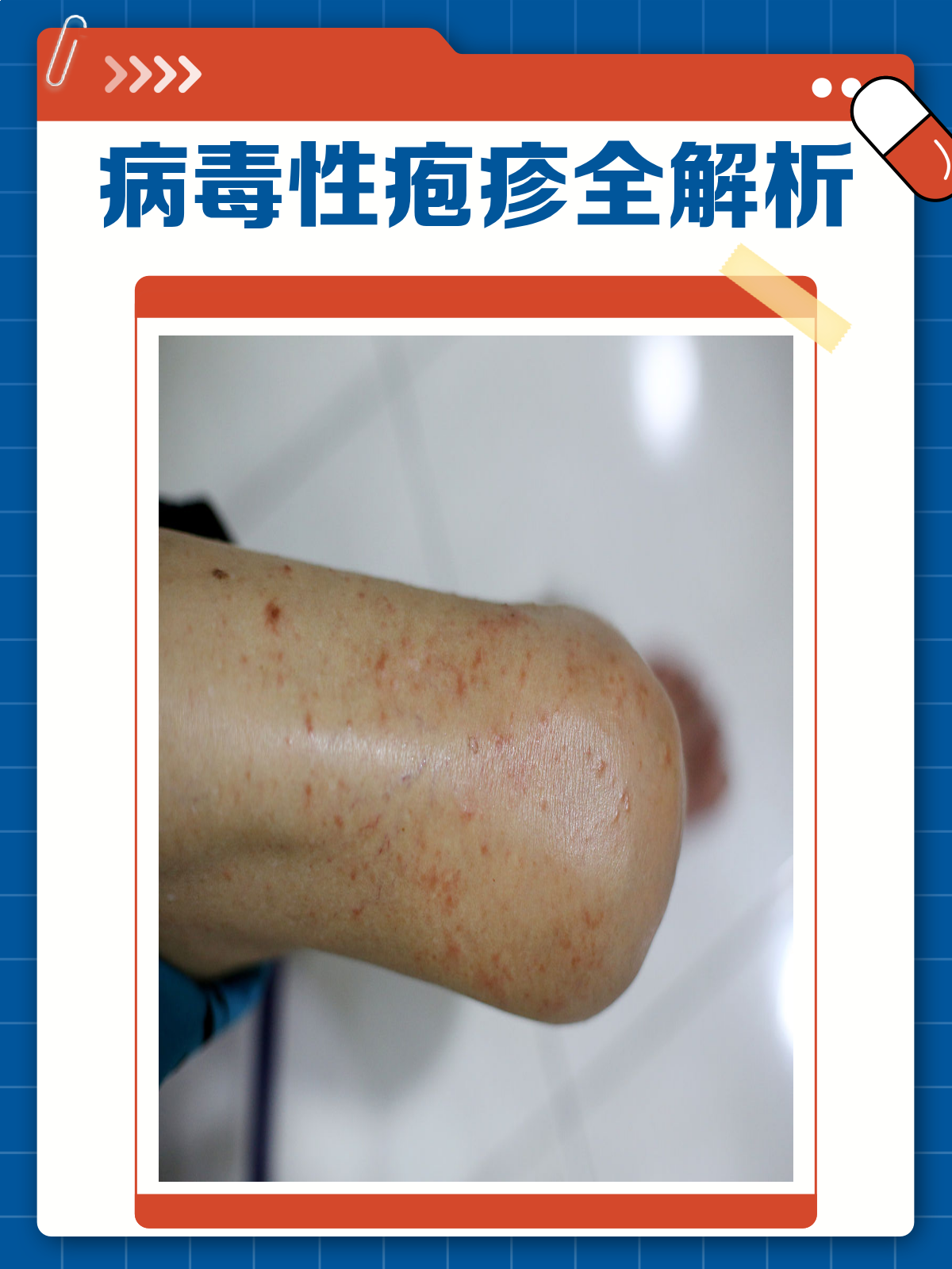  现在什么病毒感染(现在什么病毒感染,要打好证明才能上学)