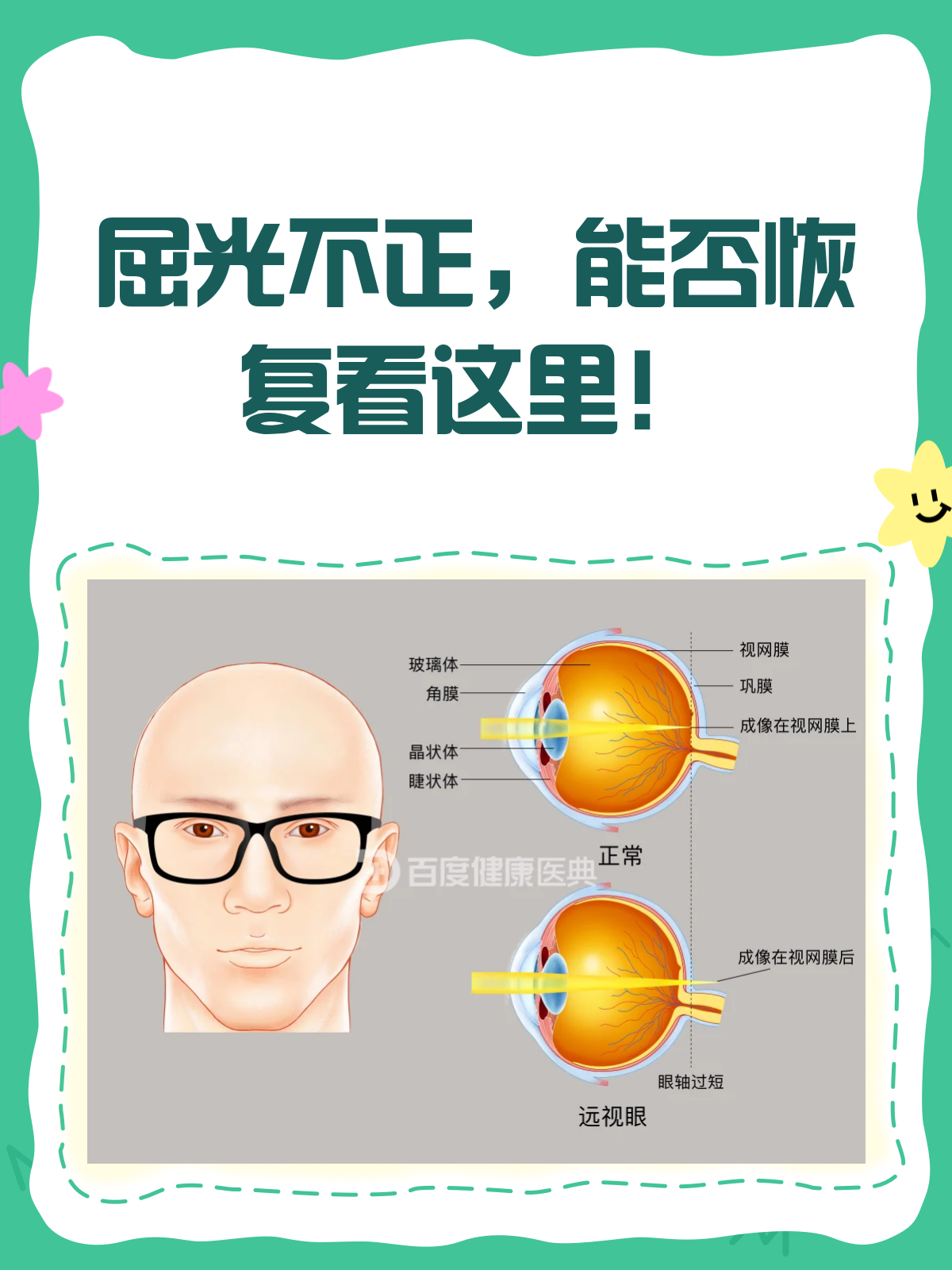 🔍 首先,什么是屈光不正?
