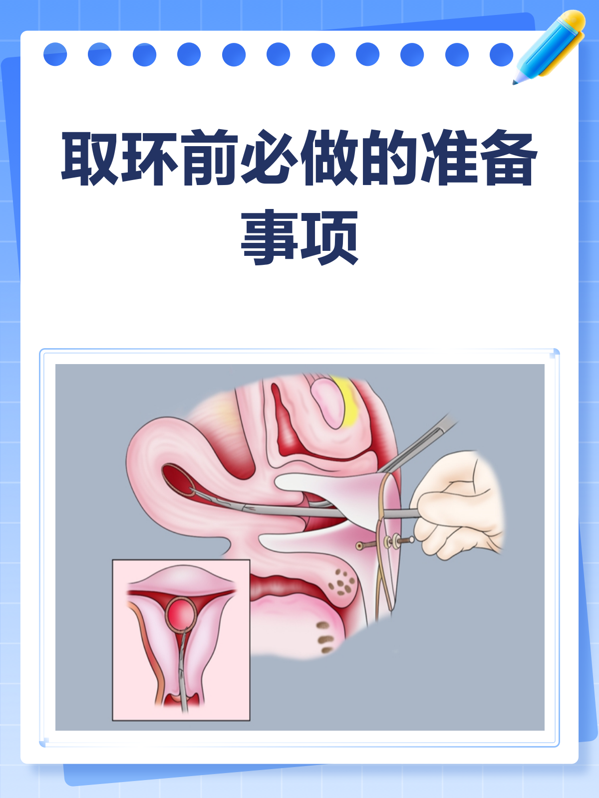 嘿,姐妹们,是不是考虑着要把体内的节育环取出来了?