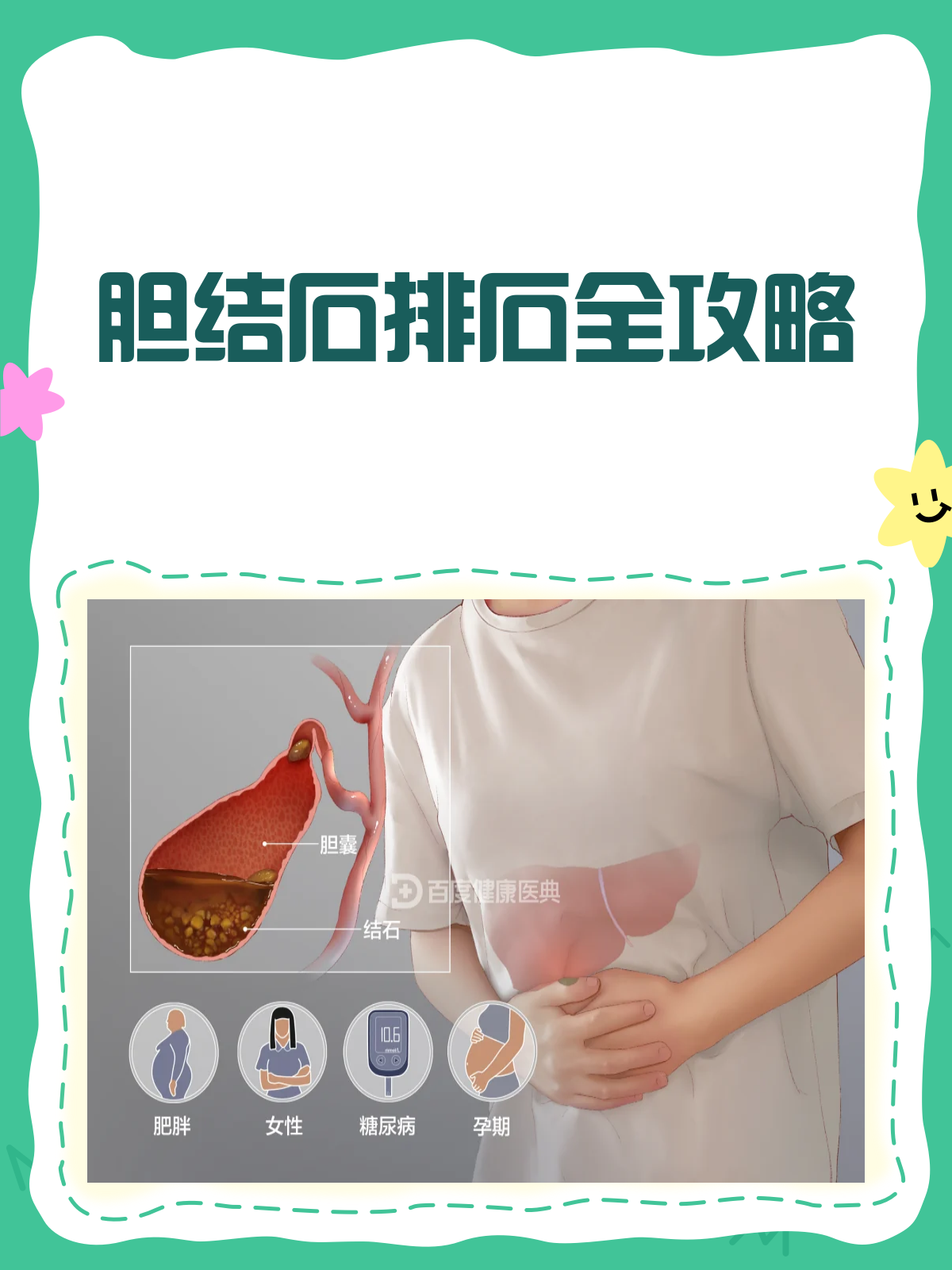 胆结石排石秘籍!选对方法,轻松告别"石"烦恼💪