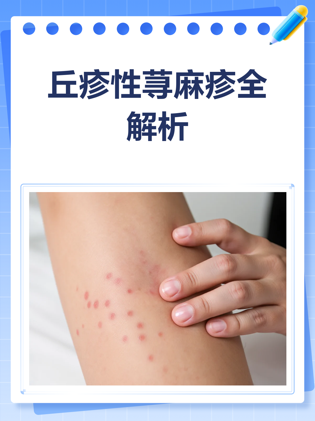 丘疹性荨麻疹,你了解多少?🔍