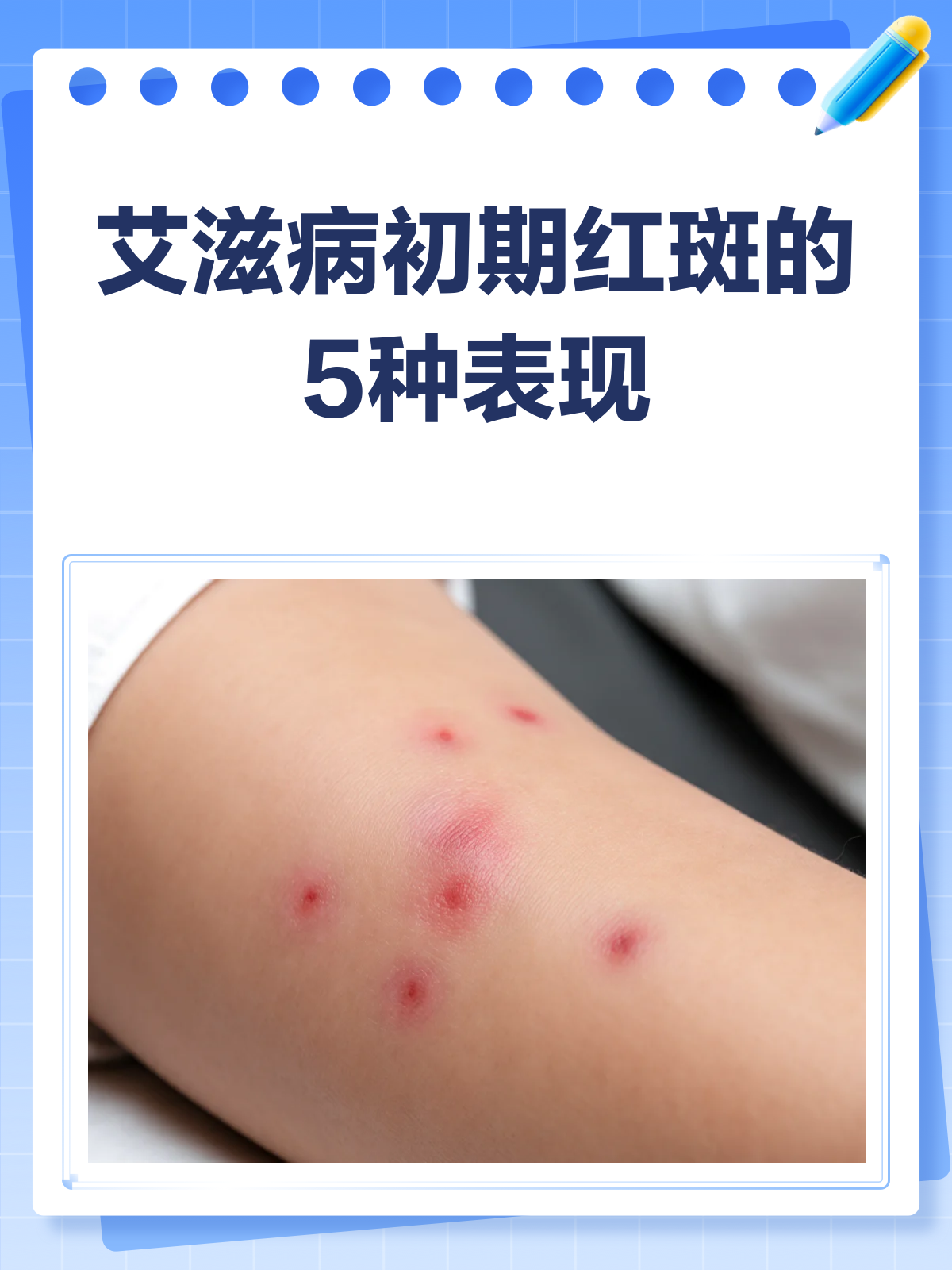 艾滋病初期皮肤红斑🚨,别误认为是普通皮肤病!