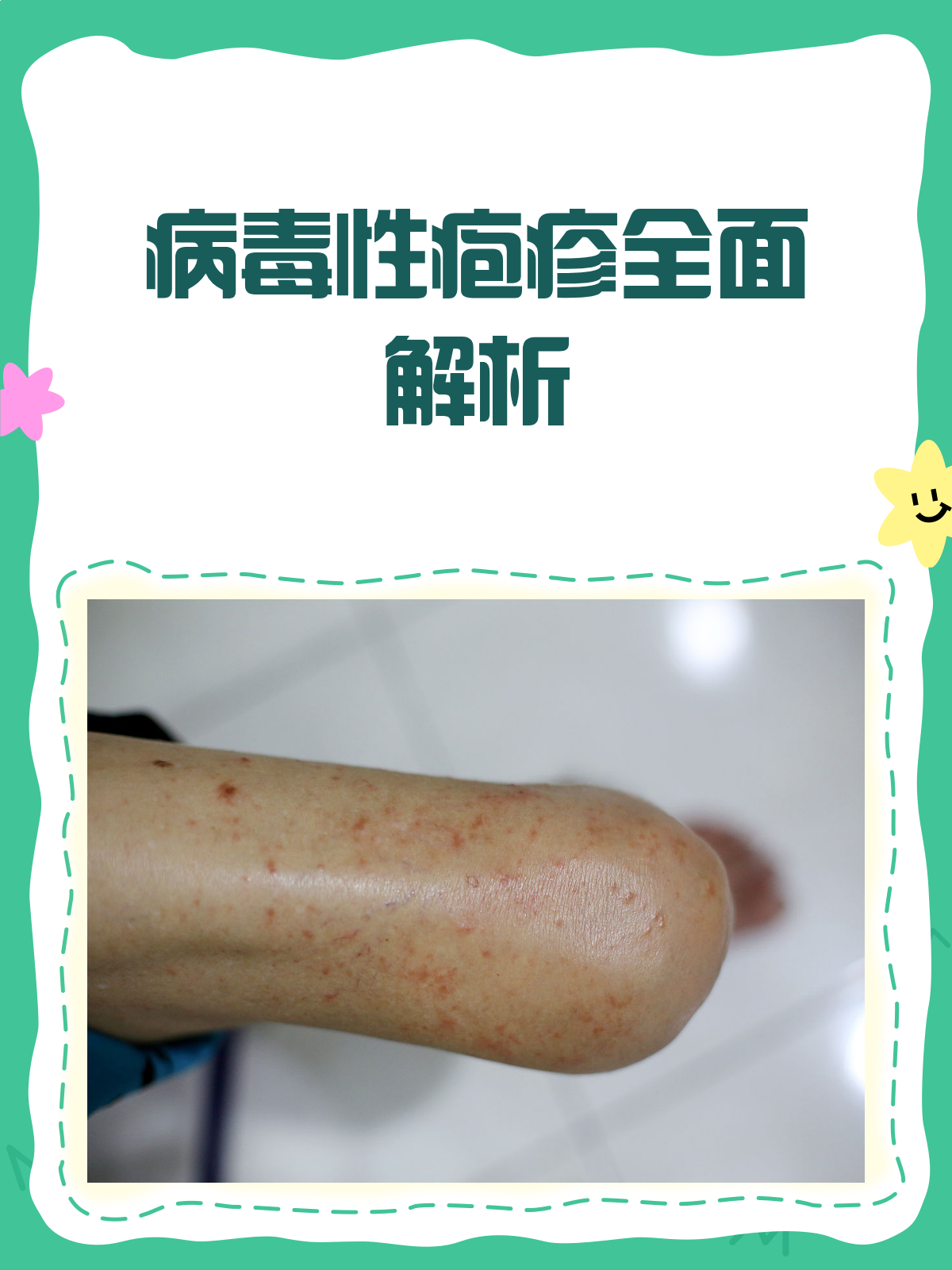  最近比较严重的病毒感染有哪些(病毒感染一般要烧几天)