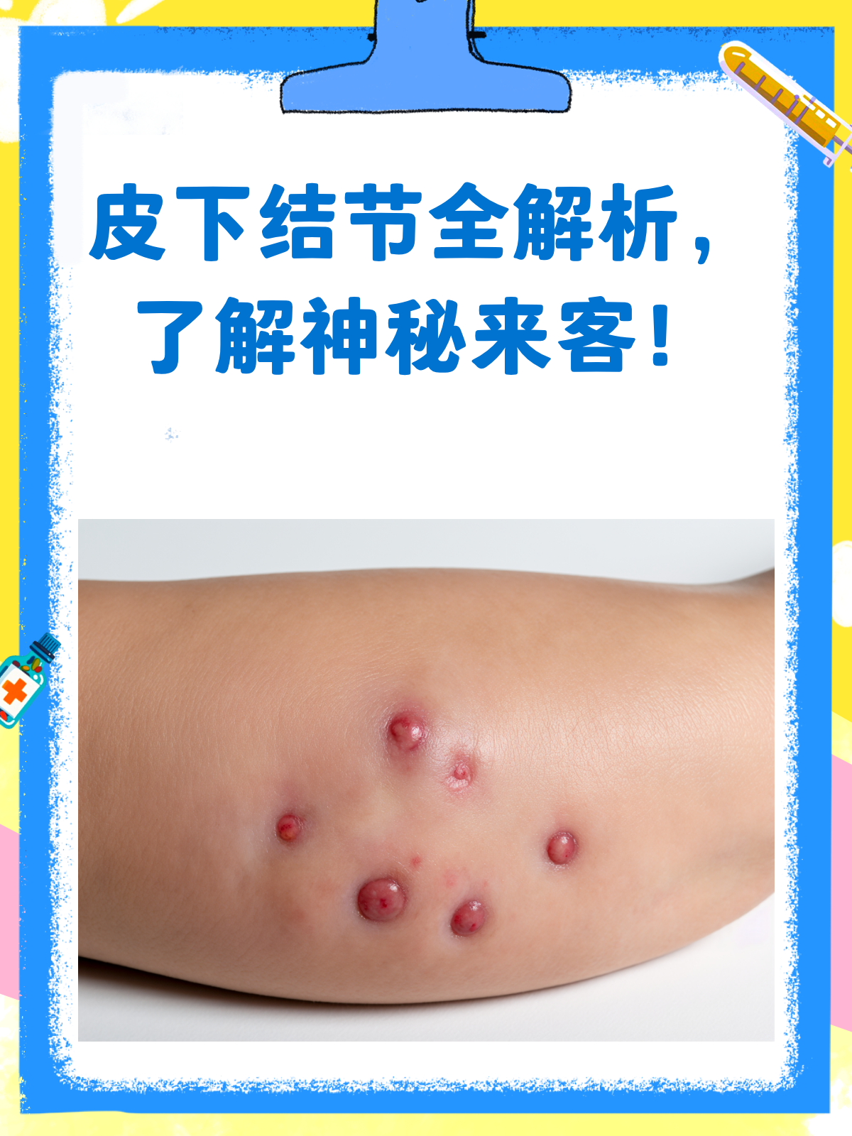 皮下结节?揭秘那些皮肤下的"神秘来客"!