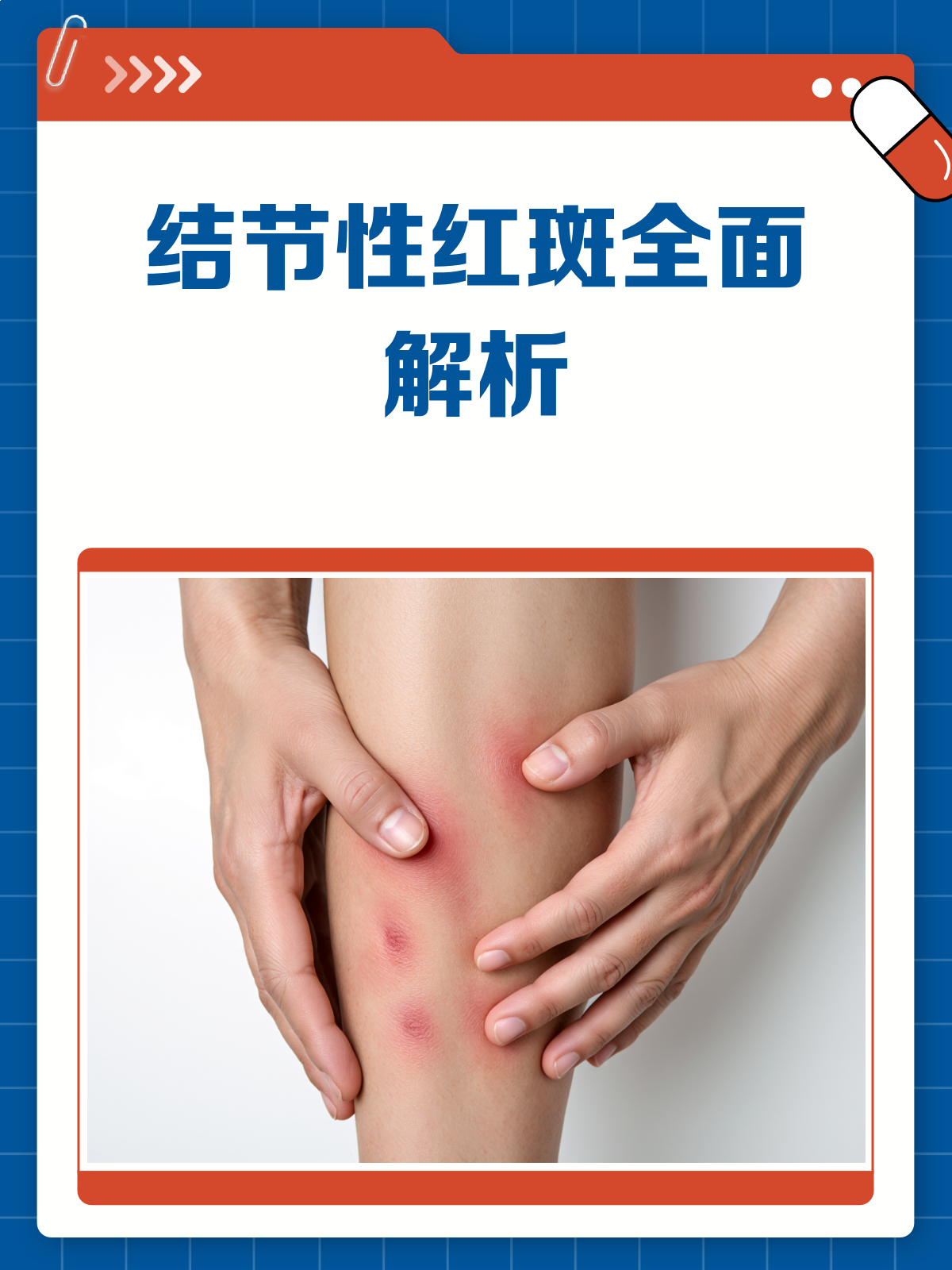 🔍结节性红斑大揭秘!你的皮肤在"说话"👀